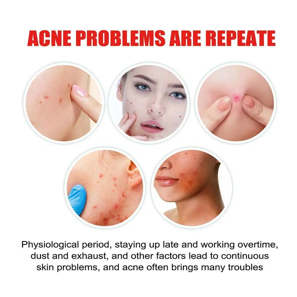 200Pcs/Set Star Shape Pimple Patches Colorful Hydrocolloid Pimple Healing Sticker Cute Strong Absorption Zit Patches Face Care